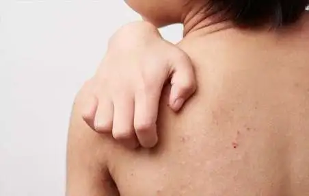 保育園でできる「あせも対策」で、子どもたちに少しでも快適な夏を！