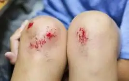 転ぶ子・転ばない子の違いを知ることで、「危ない！」で終わらせない保育へ！